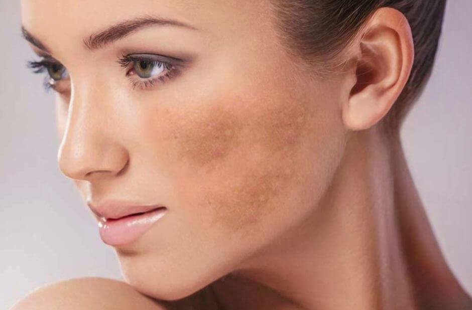 lezeres-arckezeles-pigmentfolt-eltavolitas-eltuntetes-941