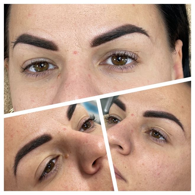 Eyebrow tattoo repair with camoflage technique